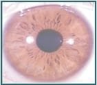 5.1The degrees of iris texture 005