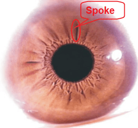 Capitolo 6 Principali segni e marcature dell'iride - 6.2 Raggi (Solco, Radii solaris) 3 6.2 Spokes Furrow Radii solaris 001