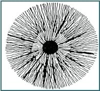 Capitolo 6 Principali segni e marcature dell’iride – 6.2 Raggi (Solco, Radii solaris)