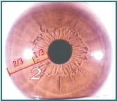 Chapter 3.2 3.1Stomach Ring 001