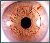 Illustrazione dell'Iridologia - Capitolo 3.2: 3.1 Anello Gastrico 3 Chapter 3.2 3.1Stomach Ring 003