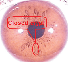 Capitolo 6 I principali segni e marcature dell’iride - 6.1 Cripte (Lesioni, Lacune) 4 Chapter 6 The major iris signs and marking 001