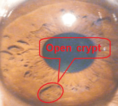 Capitolo 6 I principali segni e marcature dell’iride – 6.1 Cripte (Lesioni, Lacune)