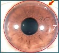 Illustration of Iridology 3.6 Skin Metabolism Ring 001