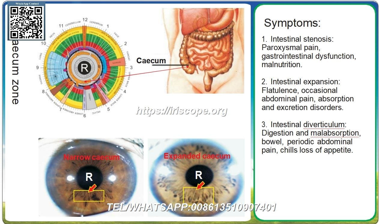 8.1 Iridologia: Cieco Stretto, Cieco Espanso e Caso 7