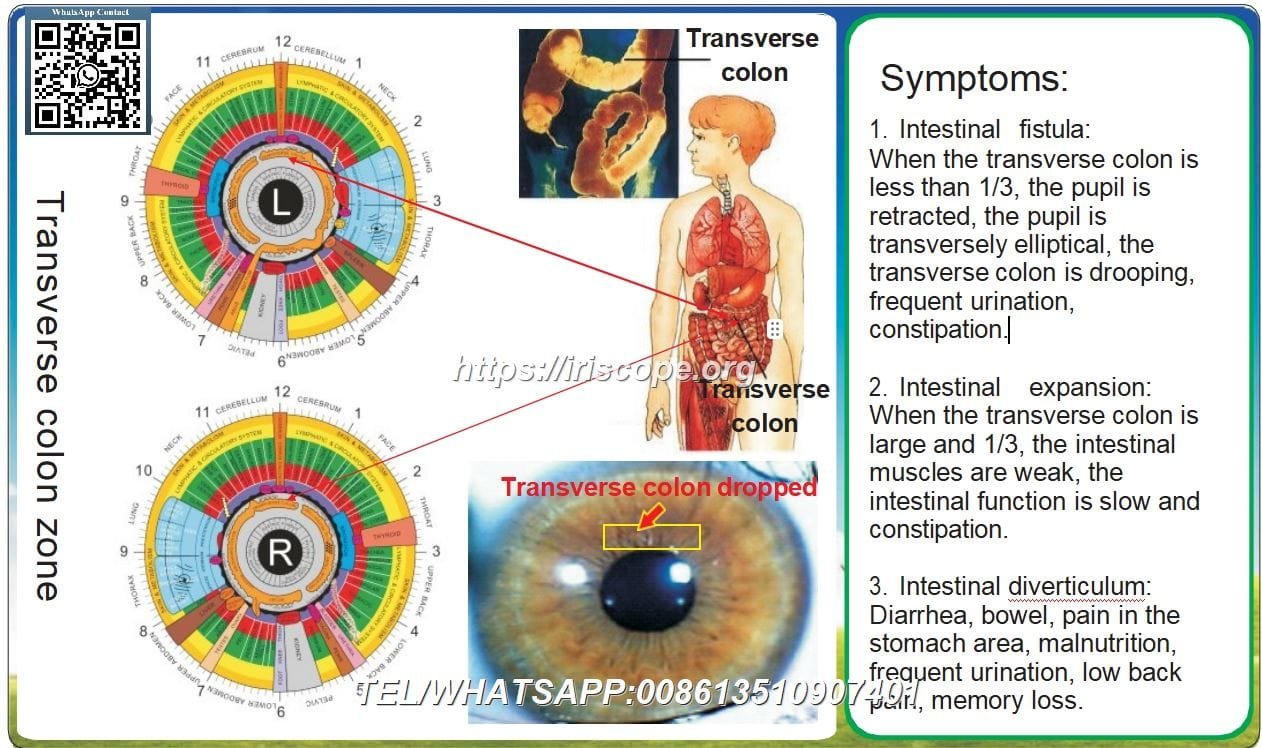 8.1 Iridologia – Colon Trasverso: Studio del Caso 8