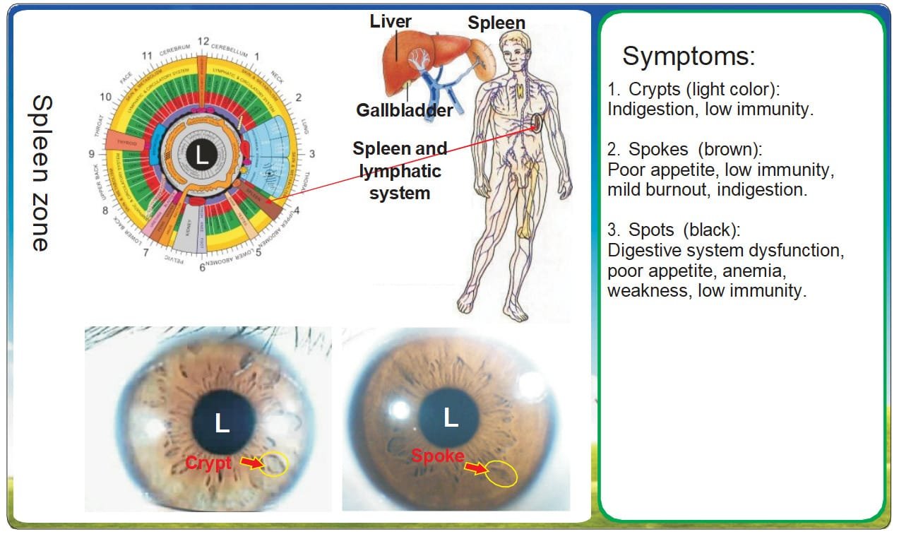 8.1 Iridologia – Zona della Milza: Segni dell'Iride e Disfunzioni Metaboliche 1 8.1 Iridologia – Zona della Milza: Segni dell'Iride e Disfunzioni Metaboliche