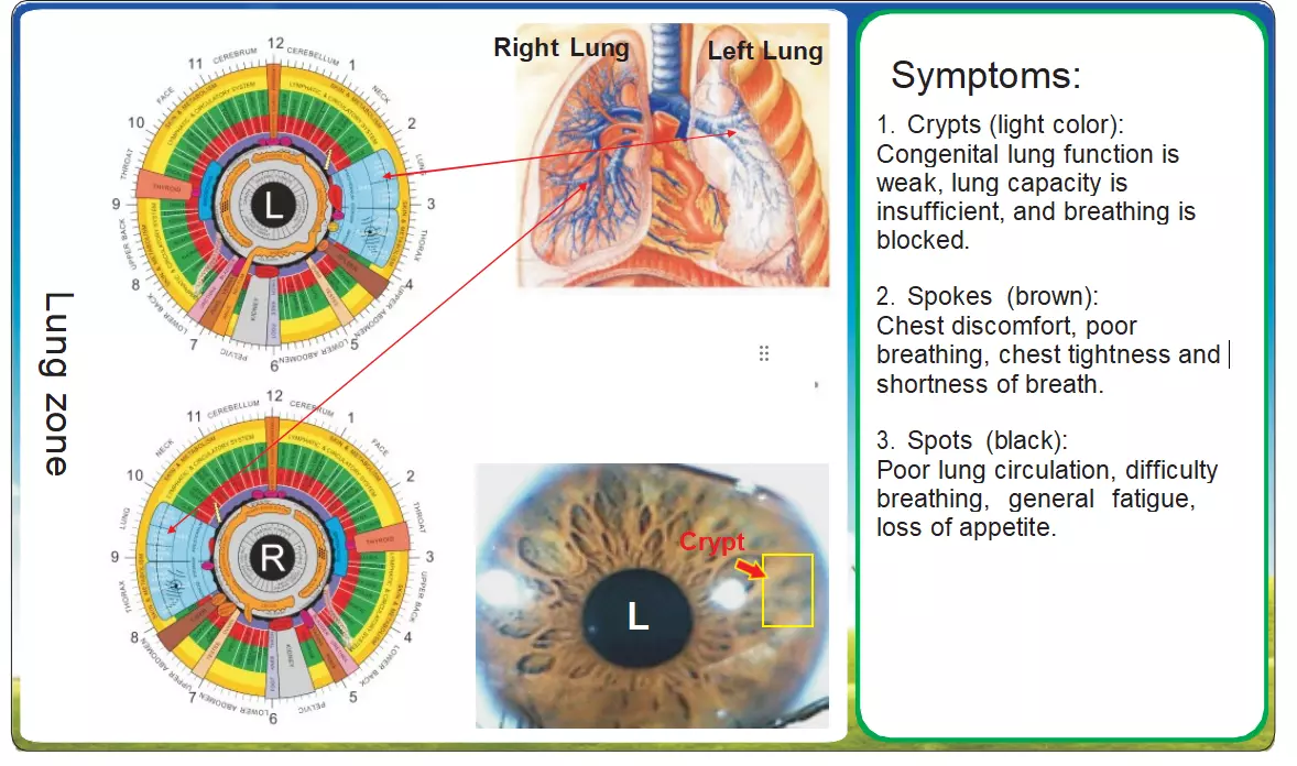 Iridologia applicata alla diagnosi polmonare – Analisi comparativa 1 Iridologia applicata alla diagnosi polmonare – Analisi comparativa