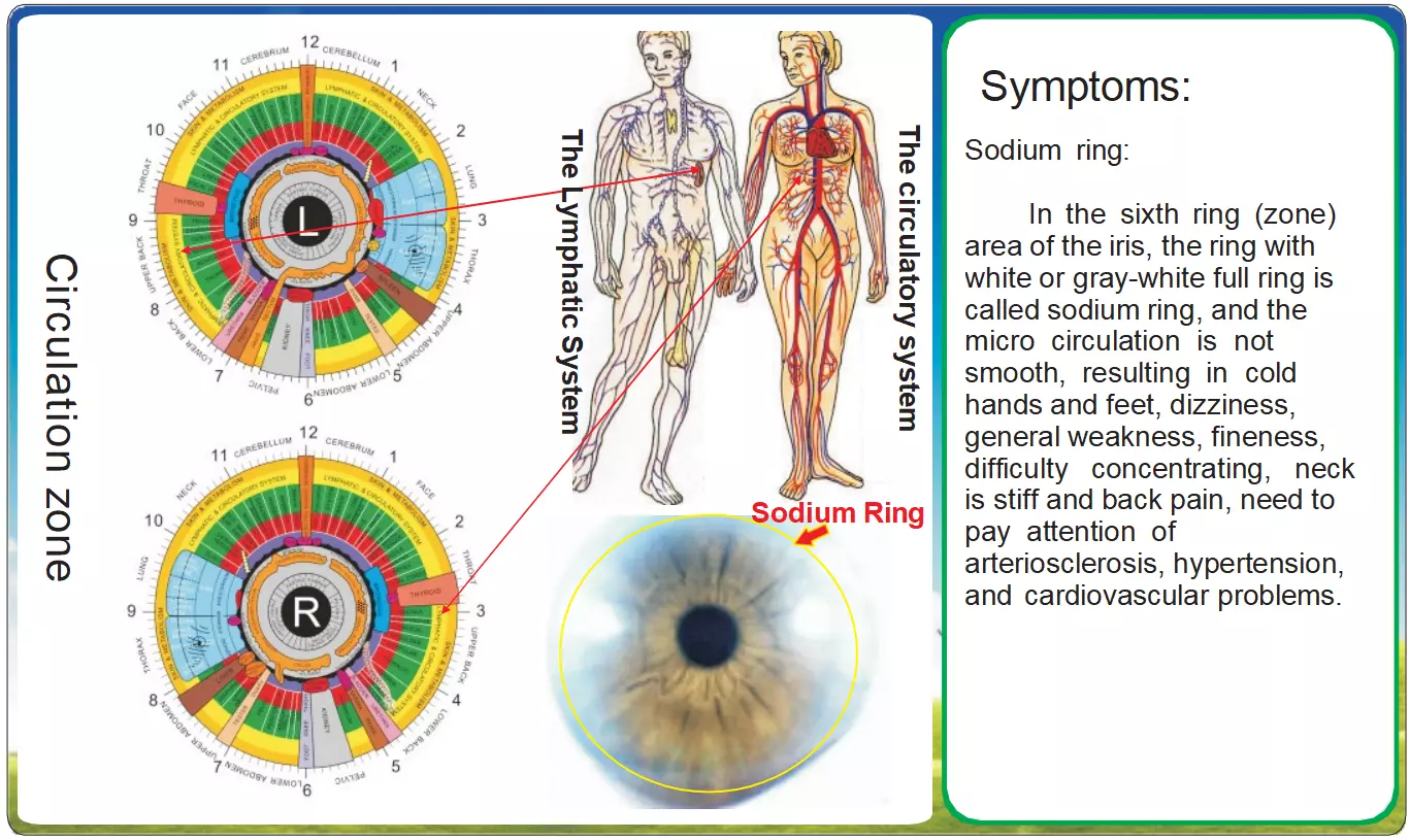 Iridologia e l'Anello di Sodio: Segnali del Sistema Circolatorio nell'Iride Un'Analisi Approfondita delle Zone Linfatica e Cardiovascolare attraverso l'Iridologia 1 Iridologia e l'Anello di Sodio: Segnali del Sistema Circolatorio nell'Iride Un'Analisi Approfondita delle Zone Linfatica e Cardiovascolare attraverso l'Iridologia