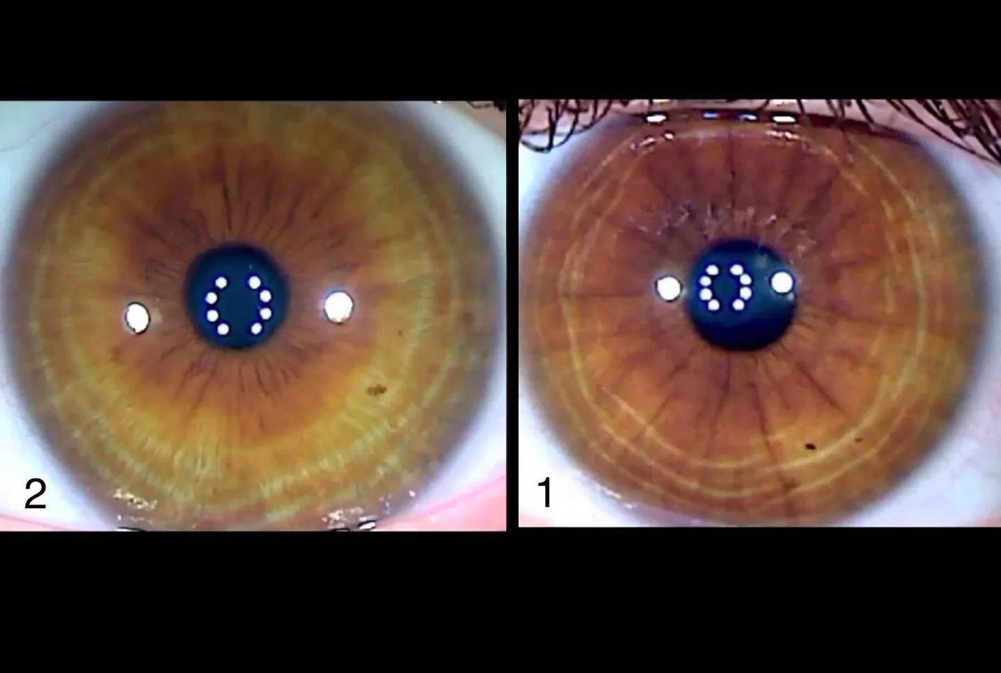 Arcus senile: cosa devono sapere acquirenti e professionisti in Italia 3 Arcus senile: cosa devono sapere acquirenti e professionisti in Italia — MAIKONG IRIDOLOGY CAMERA (1510).jpg