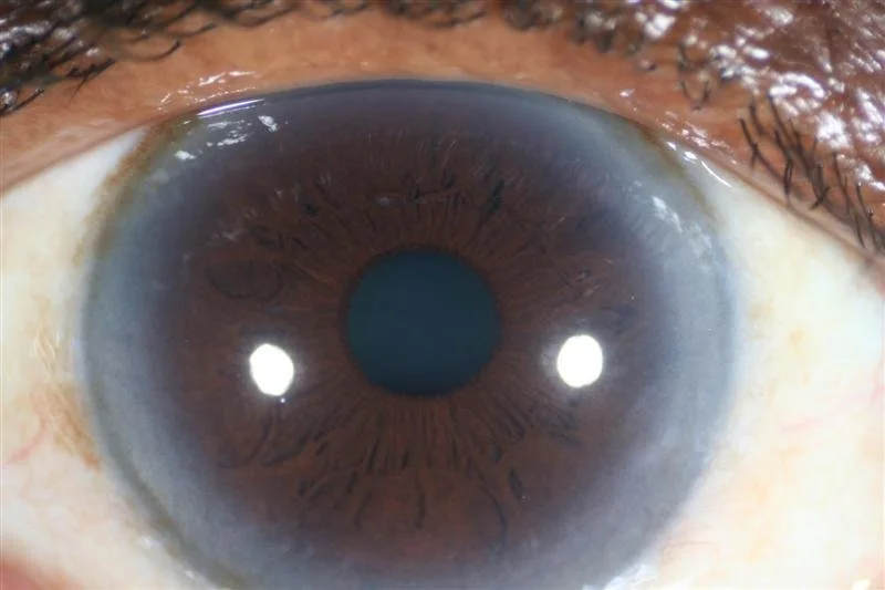 Arcus senile: cosa devono sapere acquirenti e professionisti in Italia 1 Arcus senile: cosa devono sapere acquirenti e professionisti in Italia — MAIKONG IRIDOLOGY CAMERA (350).JPG
